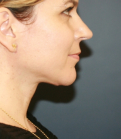 Feel Beautiful - Necklift 204 - After Photo